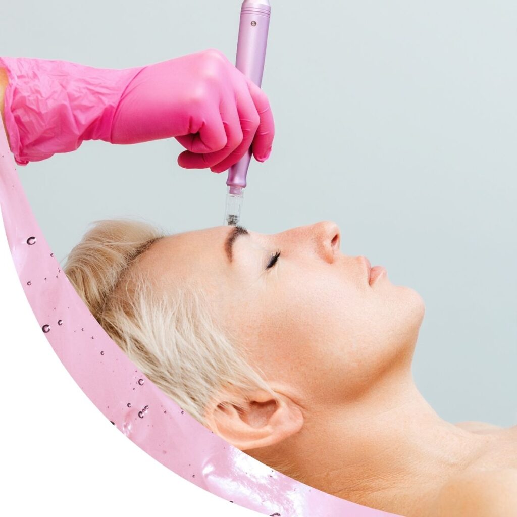 Mis on microneedling ehk mikronõelumine