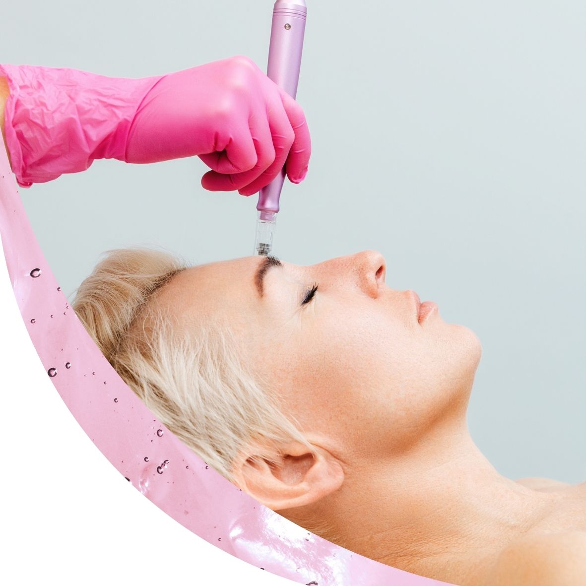 Mis on microneedling ehk mikronõelumine? Microneedling ehk mikronõelumine on naha uuendav hooldus, mille käigus tehakse nahale imepisikesed mikrotorked. Need ak